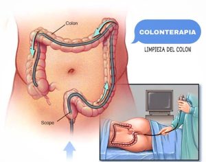 colonterapia